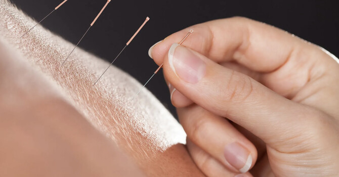 Acupuncture/Herbal Medicine